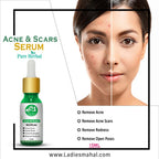 ACNE & SCARS SERUM | 20ML